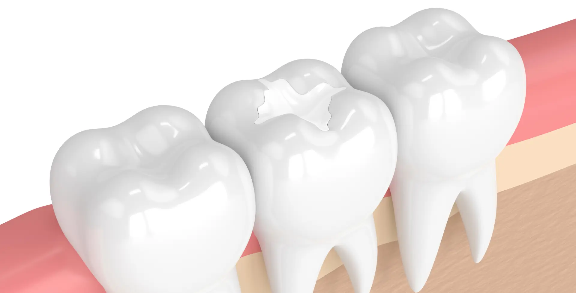 4 Signs Your Dental Filling Is Failing