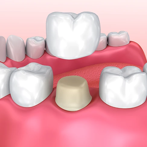 Dental crown image