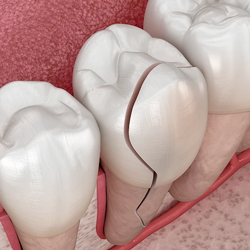Dental repairs and restoration at Brookline Smile Artists