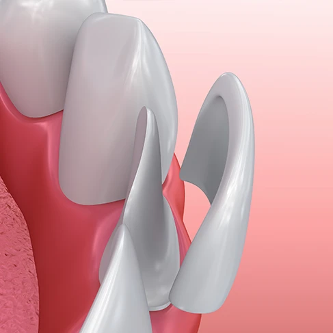 veneers image