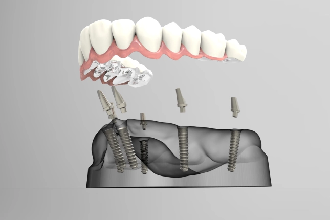 Factors That Affect the Longevity of Dental Implants