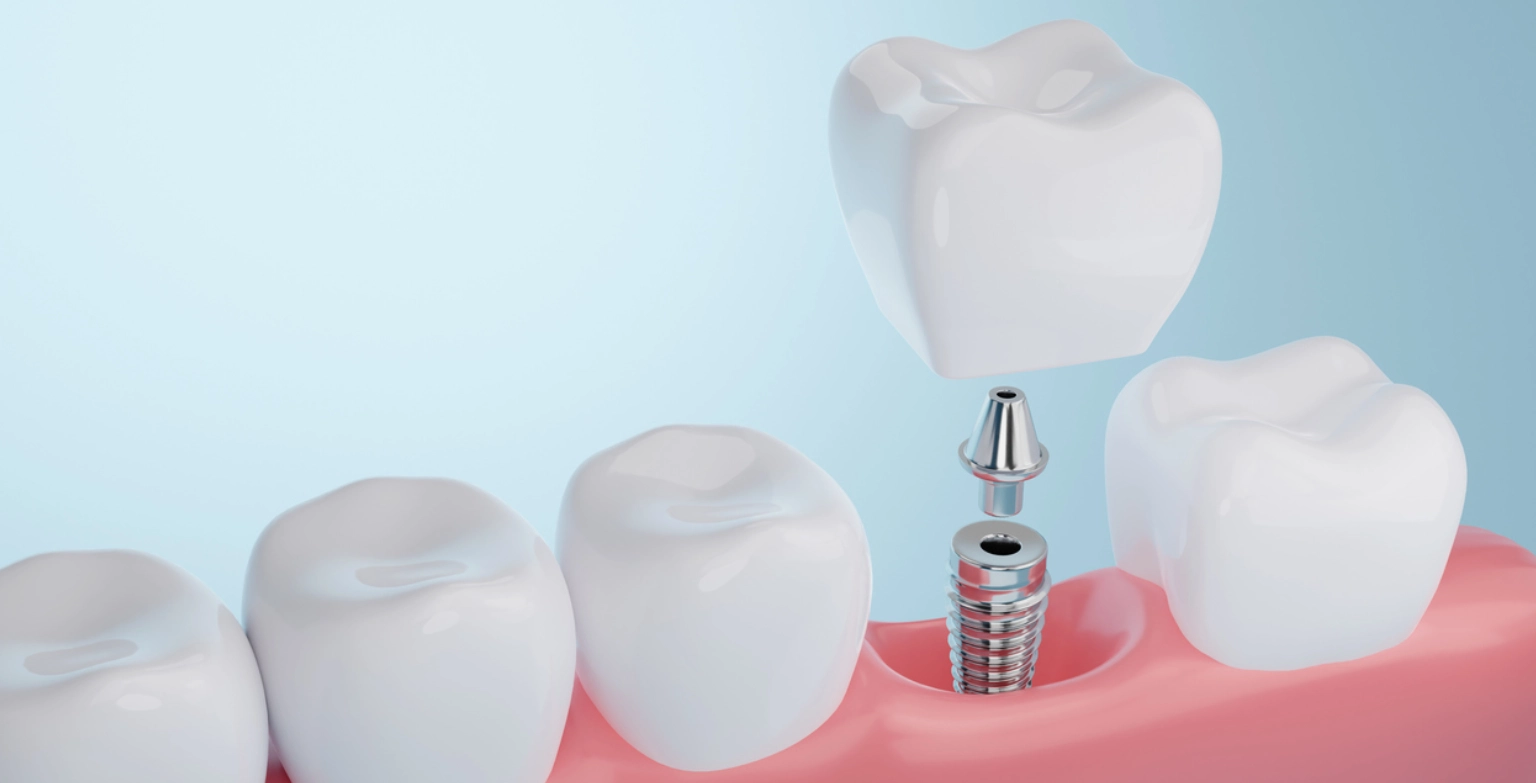 How Long Do Dental Implants Last_ (1)
