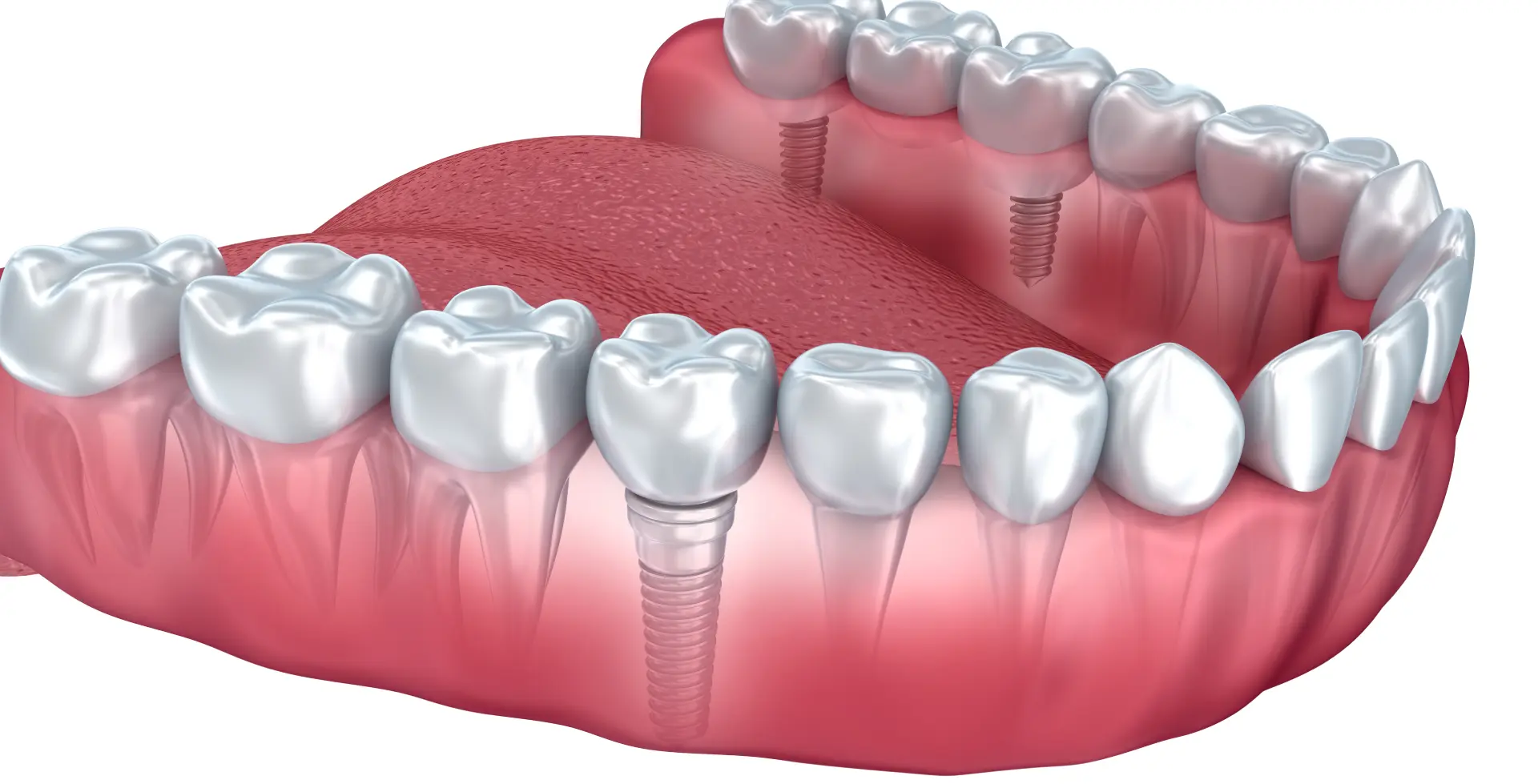 How Long Do Dental Implants Take_
