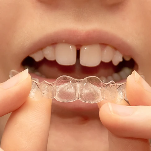 Invisalign, clear aligners at Brookline Smile Artists