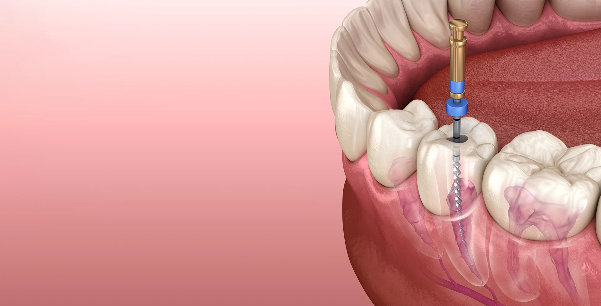 Preparing For A Root Canal Procedure