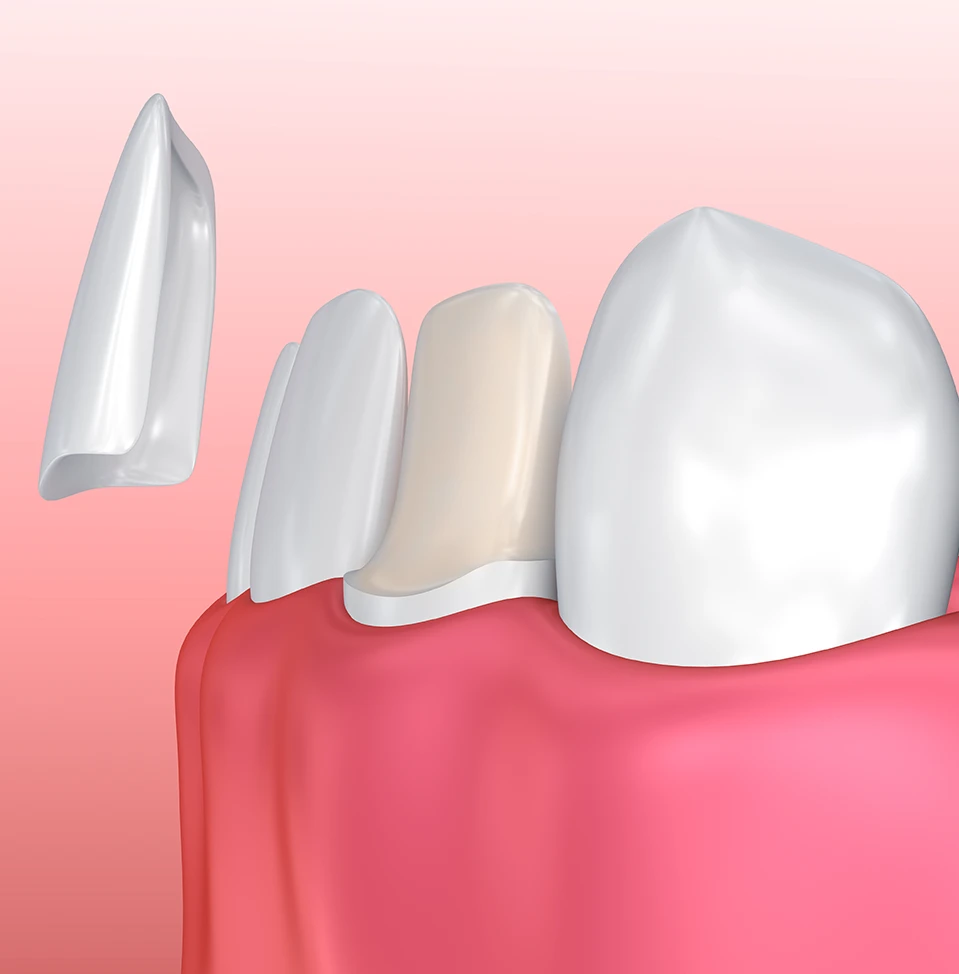 tooth cover