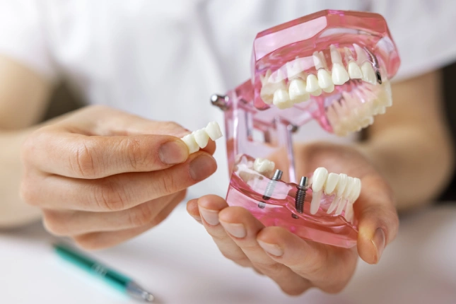 What is a Dental Implant_