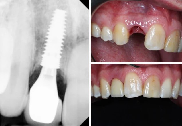 tooth extraction implant case