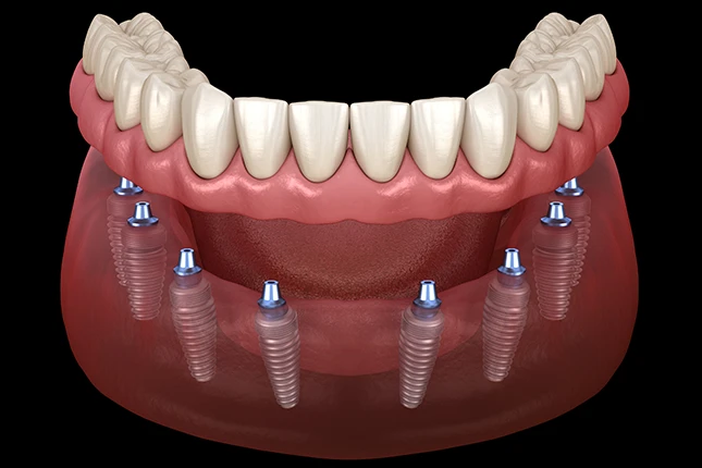 implant supported dentures