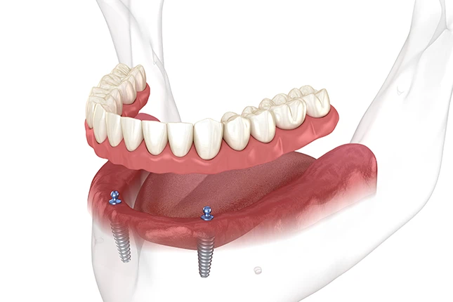 what are dentures?