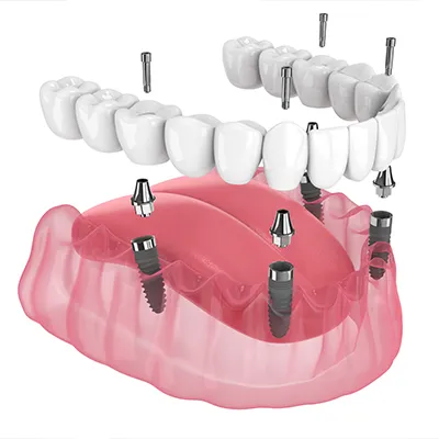 What Are All-on-4 Dental Implants