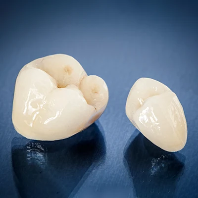 Why Do You Need Dental Crowns