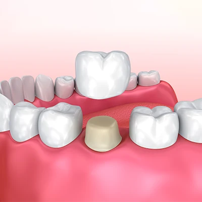 Factors That Affect the Cost of Dental Crowns
