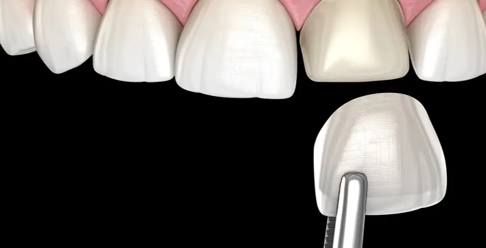 How Do Veneers Work