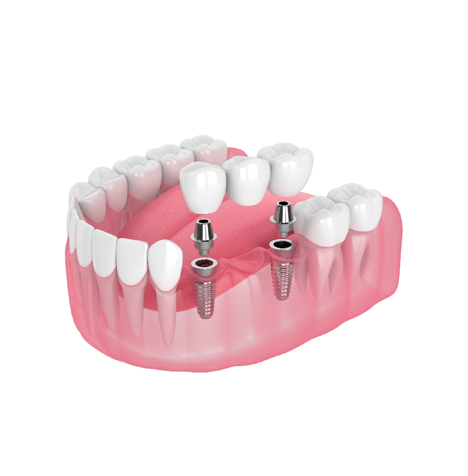 Dental Bridges in Brookline