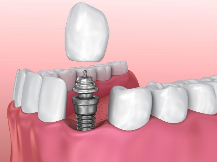 Dental Implant