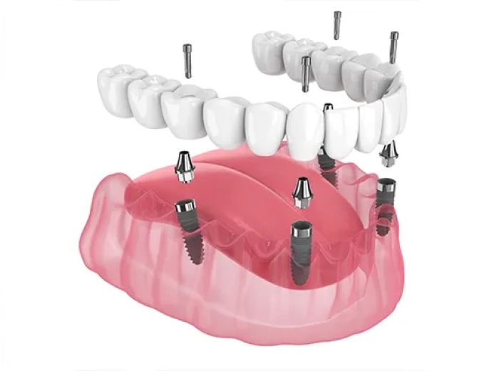 All-on-4 Dental Implants